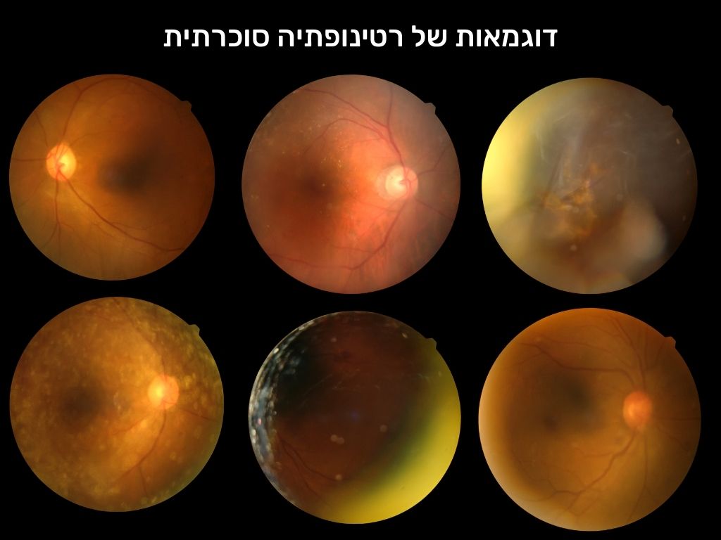 רטינופתיה סוכרתית